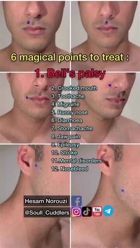 6 Magical Point To Treat Bells Palsy Acupressure Bellspalsy Healing Acupuncture