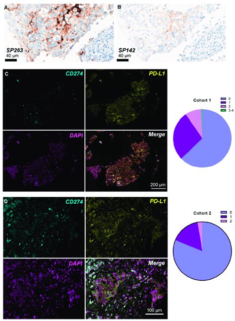 Pd L1 Expression Levels In Breast Cancer Patient Tissue Pd L1 Protein