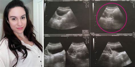 What It S Really Like To Be Born Without A Vagina Womb And Cervix