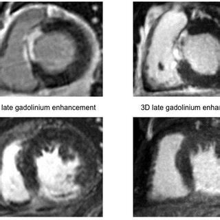 Examples for detection of myocardial scar in the septal (A) and ...