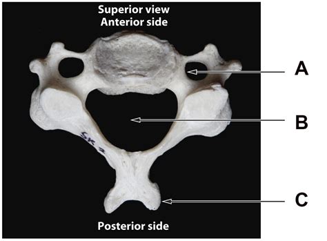 Solved Examine the cervical vertebra (neck vertebra) | Chegg.com