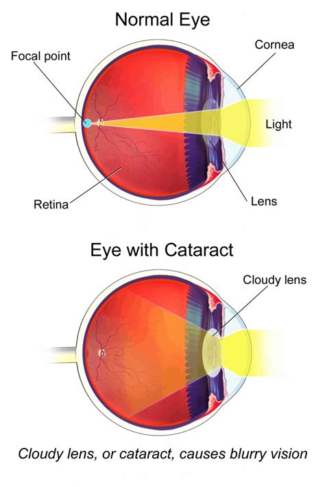 Cataracts What Is It Longleaf Eyecare