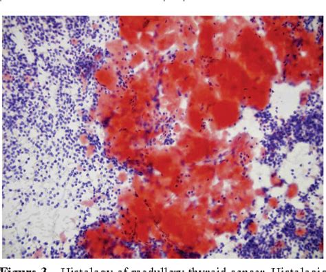 Figure 1 From Current Management Of Medullary Thyroid Cancer Semantic Scholar