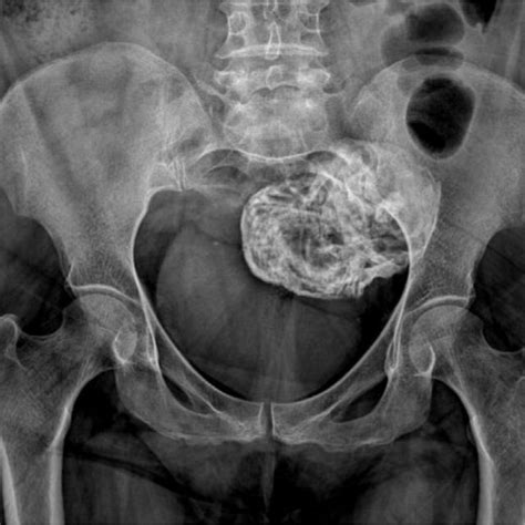 A Pelvic X Ray Shows A Calcified Mass In The Pelvic Cavity Download Scientific Diagram