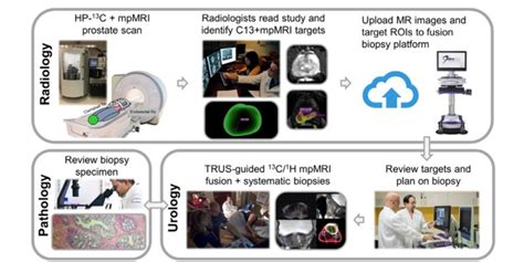 Ucsf Investigators Improve Mr Guided Trus Fusion Biopsy For Prostate Cancer Detection Using Hp