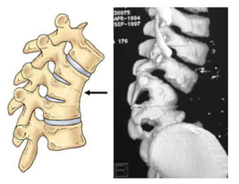 Msk Thoracic Spine Flashcards Quizlet