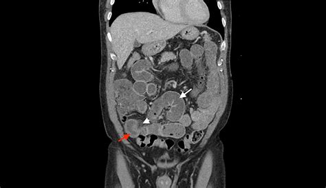 Computed Tomography Of The Abdomen And Pelvis Small Bowel Dilation