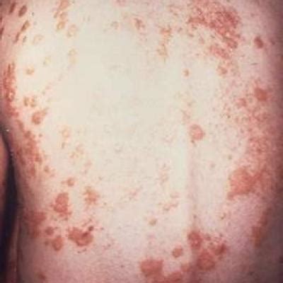 Ixekizumab For Plaque Psoriasis Improves Work Productivity Psoriasis