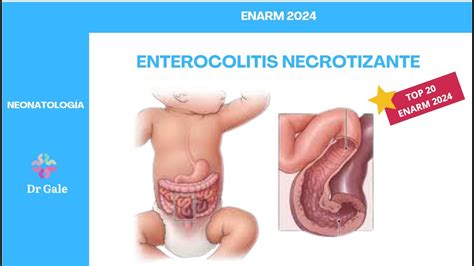 NEONATOLOGÍA ENTEROCOLITIS NECROTIZANTE ENARM 2024 YouTube