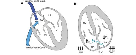A Venous Flow Patterns In The Superior Vena Cava And Inferior Vena