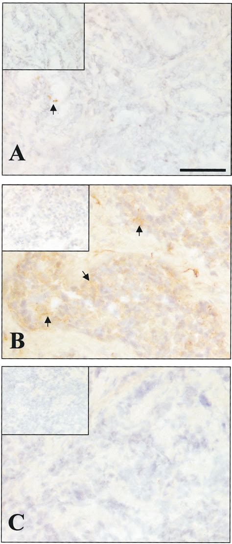 Connexin expression in prostate cancer specimens. A, rare connexin 43 ...