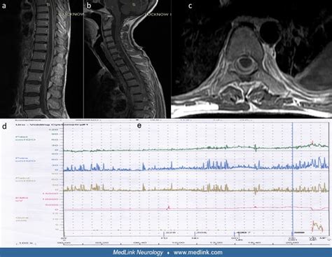 Neurogenic bladder | MedLink Neurology