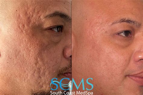 Acne Scar Removal South Coast Med Spa