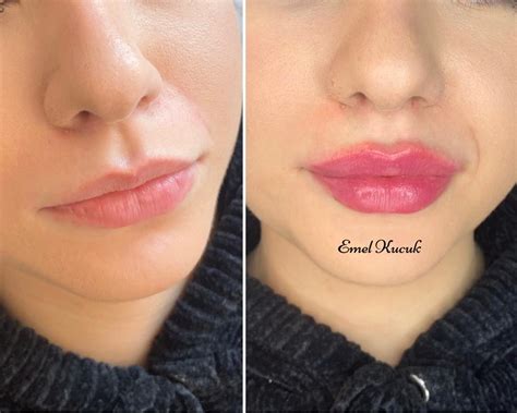 Lip Filler By London Aesthetic Cosmetician Emel Kucuk Ml Mins