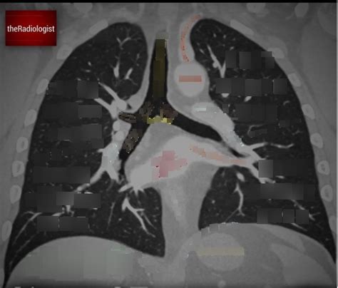 Chest Ct Coronal Diagram Diagram Quizlet