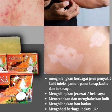 Jual Sabun Herbal Regina Penghilang Panu Jamur Kulit Panau Tinea