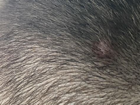 Pink Flesh Bump On Scalp R Dermatologyquestions