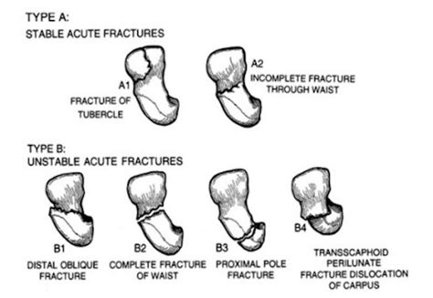 Scaphoid Fracture Classification According To Herbert And Fischer