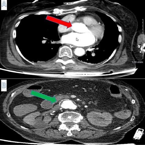 Computed Tomography Angiogram Cta Chest And Cta Abdomen And Pelvis Of