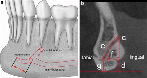 Incisive Canal Mandible