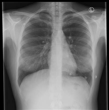 Calcification Of Lymph Nodes