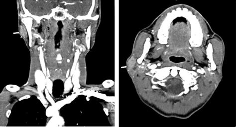 Ct Neck With Contrast Was Performed An Approximately 12 Cm Download Scientific Diagram