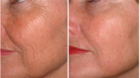 Anti Aging Laser Facial Rachels Beauty World