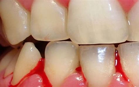 Receding Gums Slightly Red Swollen Gums Bleeding Gums Is What To Do