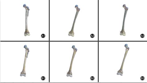 A1 A3 Osteolytic Lesions Located In The Femoral Neck Model A1 Three