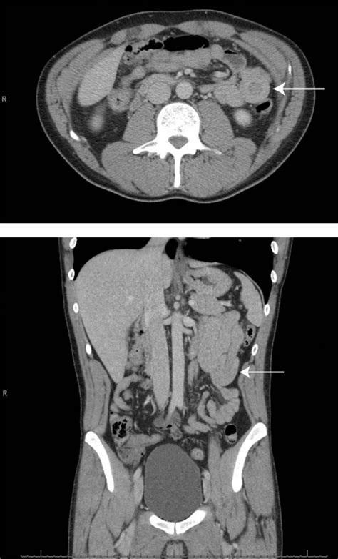 Adult Intussusception The Permanente Journal