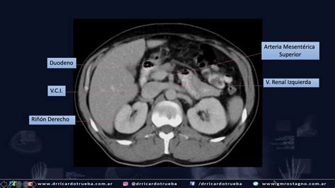 TOMOGRAFIA AXIAL BASICA DE ABDOMEN Y PELVIS YouTube