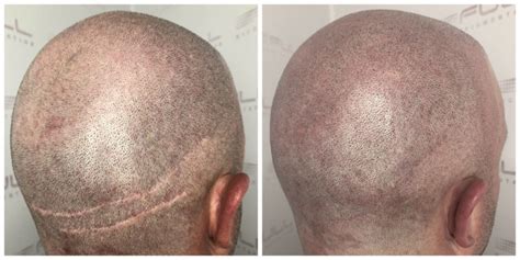 Hair Transplants Vs Scalp Micropigmentation Full Micropigmentation