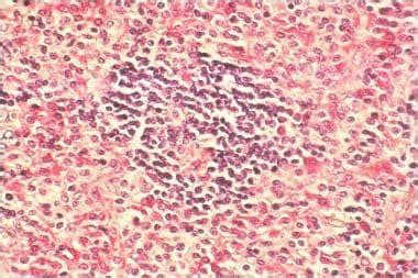 Mastocytosis Systemic Rash