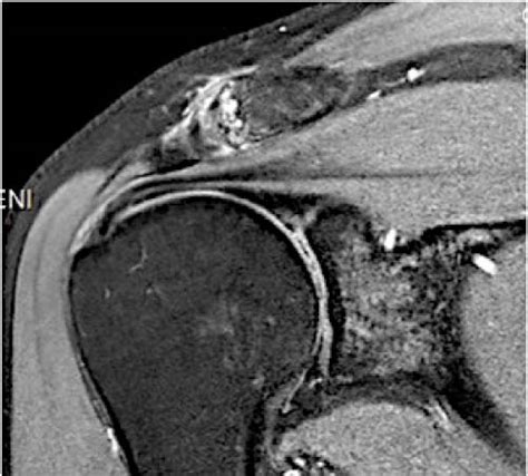 Acromioclavicular Joint Arthritis Dr Raymond Yu