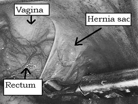 Laparoscopic view of hernia sac. | Download Scientific Diagram