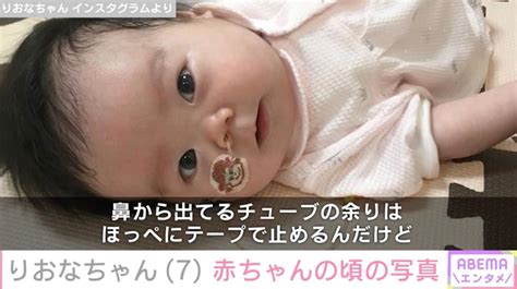 先天性疾患による低身長・りおなちゃん（7）「鼻から胃に通したチューブで栄養をとっていました」生後間もない写真を公開 エンタメ総合 Abema Times アベマタイムズ