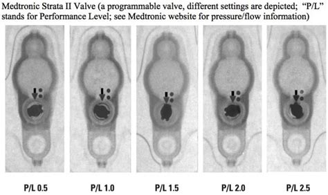 BRG - Reading Skull Films for Shunt Valve Settings