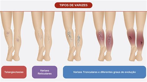 Varizes O Que S O Principais Causas E Como Tratar