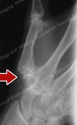 Osteoarthritis Hands X Ray