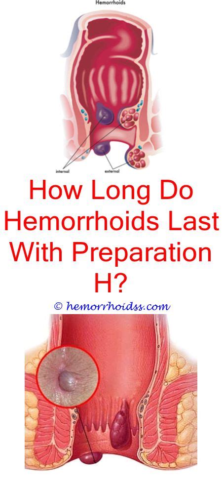 Pin On How To Heal Hemorrhoids