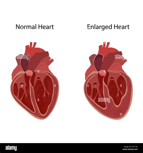 Normal And Enlarged Heart Illustration Stock Photo Alamy