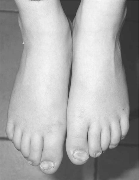 Dysplastic And Spoon Shape Of Foot Nails Download Scientific Diagram