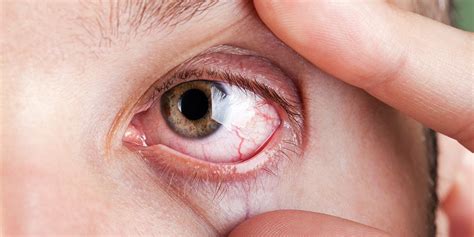 Scratchy Eyes: 7 Things That Can Cause This Irritating Symptom | SELF