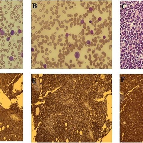 A Peripheral Film Showing Medium Sized Blasts B Bone Marrow