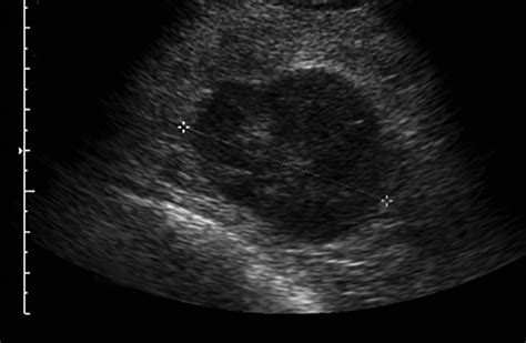 Phyllodes Tumor Of The Breast Ultrasound Pathology Correlation Ajr