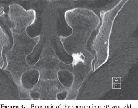 Osteitis Fibrosa Cystica Semantic Scholar