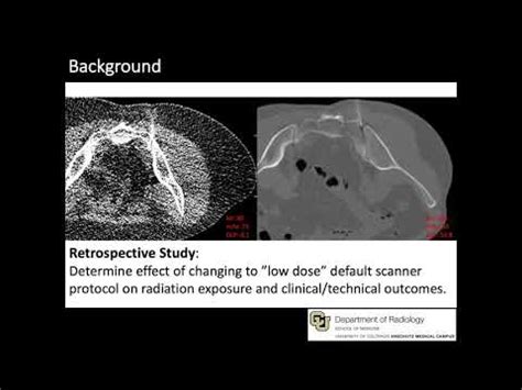 Radiation Exposure Reduction For Computerized Tomography Guided