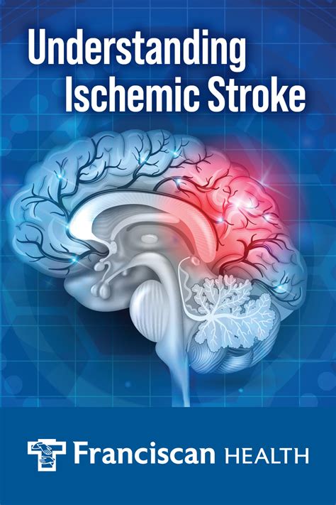 Understanding Ischemic Stroke Franciscan Health