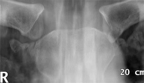 Sternoclavicular Joint dislocation Archives • LITFL