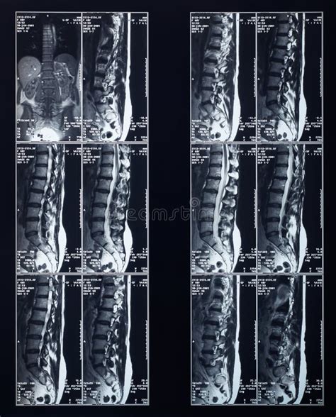 X 射线脊椎造影 库存图片 图片 包括有 辐射 医学 诊断 医疗 照片 光芒 联接 疾病 45828101